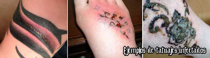 Tatuajes infectados